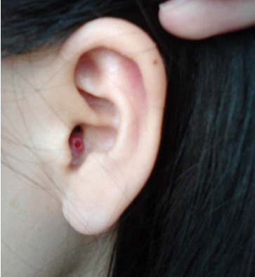 外耳道疖肿预防与护理
